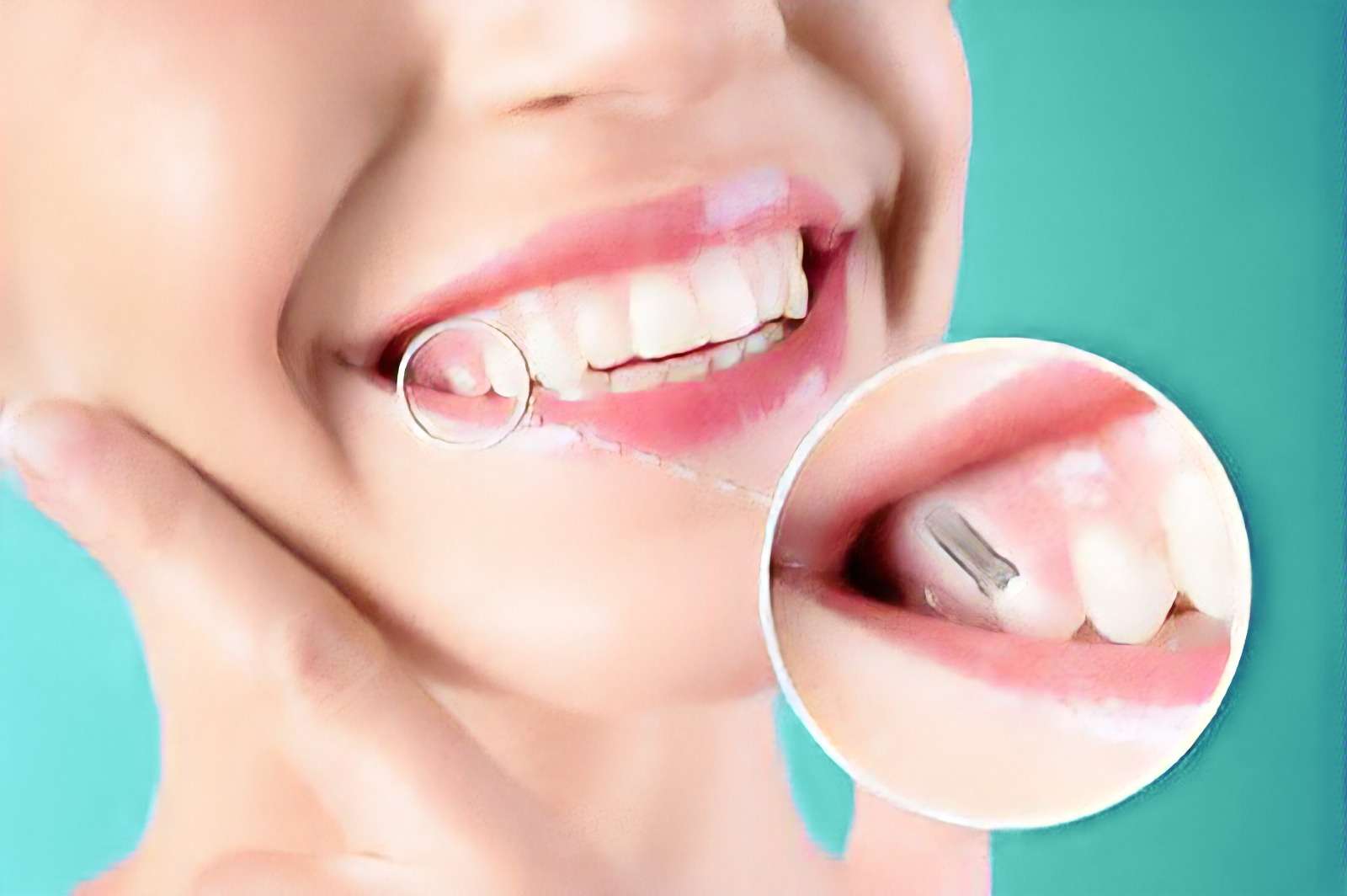 implantologia dentale offerta studio dentistico torino